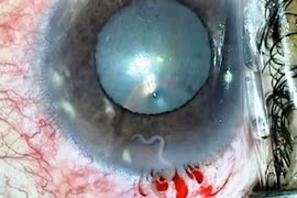 Phẫu thuật gắp giun đũa chó trong mắt bệnh nhân