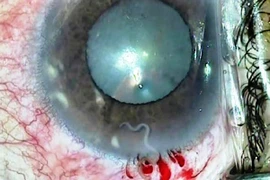 Phẫu thuật gắp giun đũa chó trong mắt bệnh nhân