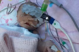 Bé sơ sinh nhỏ tuổi nhất thế giới được phẫu thuật tim