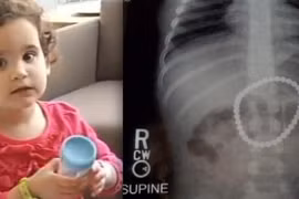 Bé 3 tuổi nuốt 37 viên nam châm