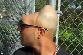 Kỳ lạ chàng trai sống với nửa hộp sọ