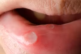 Mẹo ngăn ngừa loét miệng tái phát
