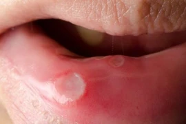 Mẹo ngăn ngừa loét miệng tái phát