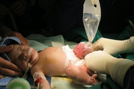 Phẫu thuật cứu sống bé gái sơ sinh nội tạng nằm ngoài ổ bụng