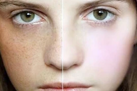 Thực phẩm trị tàn nhang