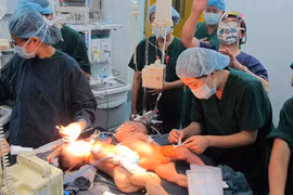 Tách rời thành công 2 trẻ sinh đôi 4 tháng tuổi