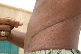 Gia tăng những vụ buôn bán nội tạng người khét tiếng và tàn bạo