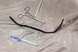 Thách đố nhau, nuốt sợi dây điện gần 40cm