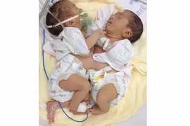 Hai trẻ sơ sinh dính nhau phần bụng