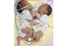 Hai trẻ sơ sinh dính nhau phần bụng