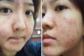 Đừng ham kem trắng da siêu tốc