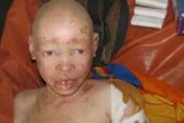 Gia tăng nạn sát hại người bị bệnh bạch tạng để cầu may