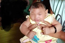 Phát hiện thêm 2 trẻ bị chứng đầu nhỏ bẩm sinh tại Đắc Lắk