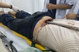 Bị thanh sắt dài 2m đâm xuyên vùng thắt lưng