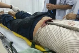 Bị thanh sắt dài 2m đâm xuyên vùng thắt lưng