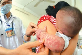 Hà Nội ghi nhận rải rác bệnh nhân mắc sởi