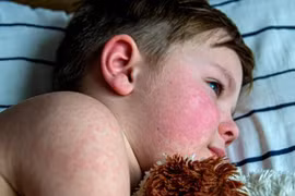 Dịch sởi đang gia tăng ảnh hưởng đến trẻ em trong độ tuổi đi học tại Mỹ