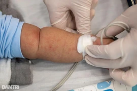 Một trẻ ở Nam Từ Liêm tử vong do sởi, ghi nhận 3 ổ dịch tay chân miệng tại Hà Đông