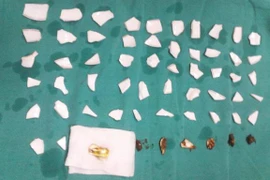 Hy hữu: Cứu sống bệnh nhân nuốt 59 mảnh chén vỡ vào bụng