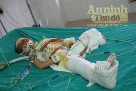 Vụ nổ xe máy kinh hoàng: Bé Vân được đưa về quê vì quá nguy kịch