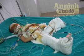 Vụ nổ xe máy kinh hoàng: Bé Vân được đưa về quê vì quá nguy kịch