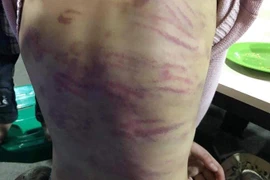 Thêm một trường hợp bé gái 6 tuổi tử vong nghi bị bạo hành