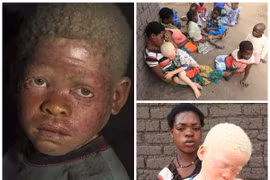 Nỗi ám ảnh của người mẹ có con bị chặt đầu vì nạn "săn người bạch tạng"