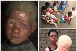 Nỗi ám ảnh của người mẹ có con bị chặt đầu vì nạn "săn người bạch tạng"