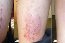 Điều trị viêm da cơ địa mạn tính 