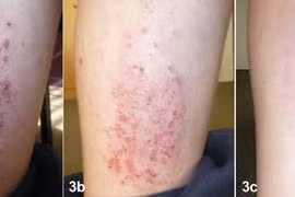 Điều trị viêm da cơ địa mạn tính 