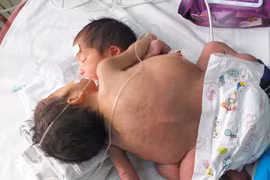Mổ tạo hình để cứu sống 2 cháu