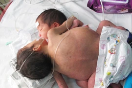 Mổ tạo hình để cứu sống 2 cháu