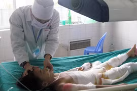 Đắp thuốc nam chữa bỏng: Nhiều trẻ tử vong, tai biến nặng