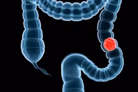 Phòng tránh ung thư ruột kết