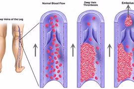 Chân sưng to, coi chừng cục máu đông