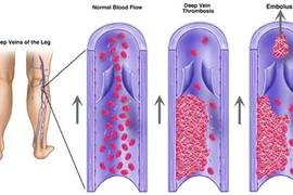 Chân sưng to, coi chừng cục máu đông