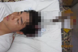 Phẫu thuật rút dao phay cắm trong đầu nam sinh viên