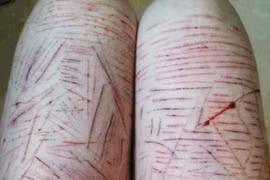 Xôn xao bởi hình ảnh thiếu nữ tự tay rạch đùi