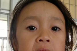 Bé gái 3 tuổi có khuôn mặt như bà già 60