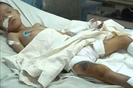 Bom bi phát nổ, 3 học sinh thương vong