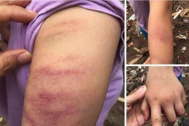 Dùng thước đánh bầm tay học sinh, cô giáo tiểu học Mễ Trì bị đình chỉ dạy học