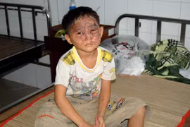 Một bé trai bị bỏng nặng khi đang chơi lồng đèn trung thu