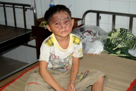 Một bé trai bị bỏng nặng khi đang chơi lồng đèn trung thu