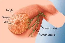 Thử nghiệm hướng mới trong điều trị ung thư vú
