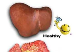 Phát hiện các yếu tố nguy cơ của ung thư gan
