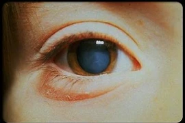 Hút thuốc lá làm tăng nguy cơ đục thủy tinh thể