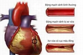 Hóa chất trong sản phẩm gia dụng gây nguy cơ bệnh tim