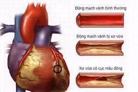 Hóa chất trong sản phẩm gia dụng gây nguy cơ bệnh tim