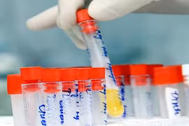 Đoán bệnh qua nước tiểu