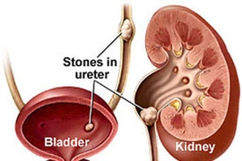 Thêm hy vọng cho bệnh nhân thận